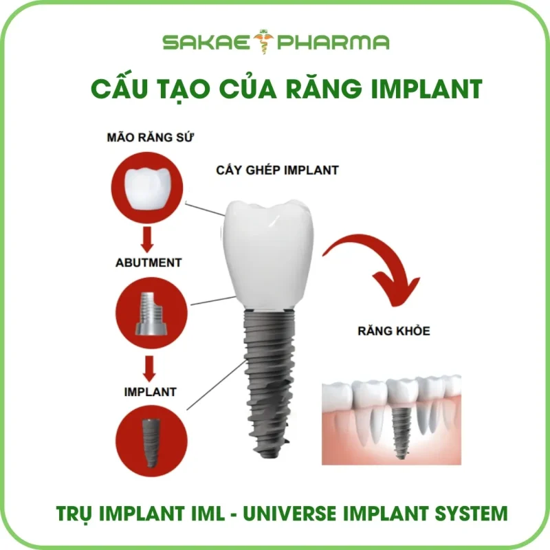 Cấu tạo răng implant hoàn chỉnh