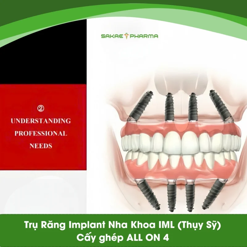 Cấy ghép All On 4 trụ implant IML