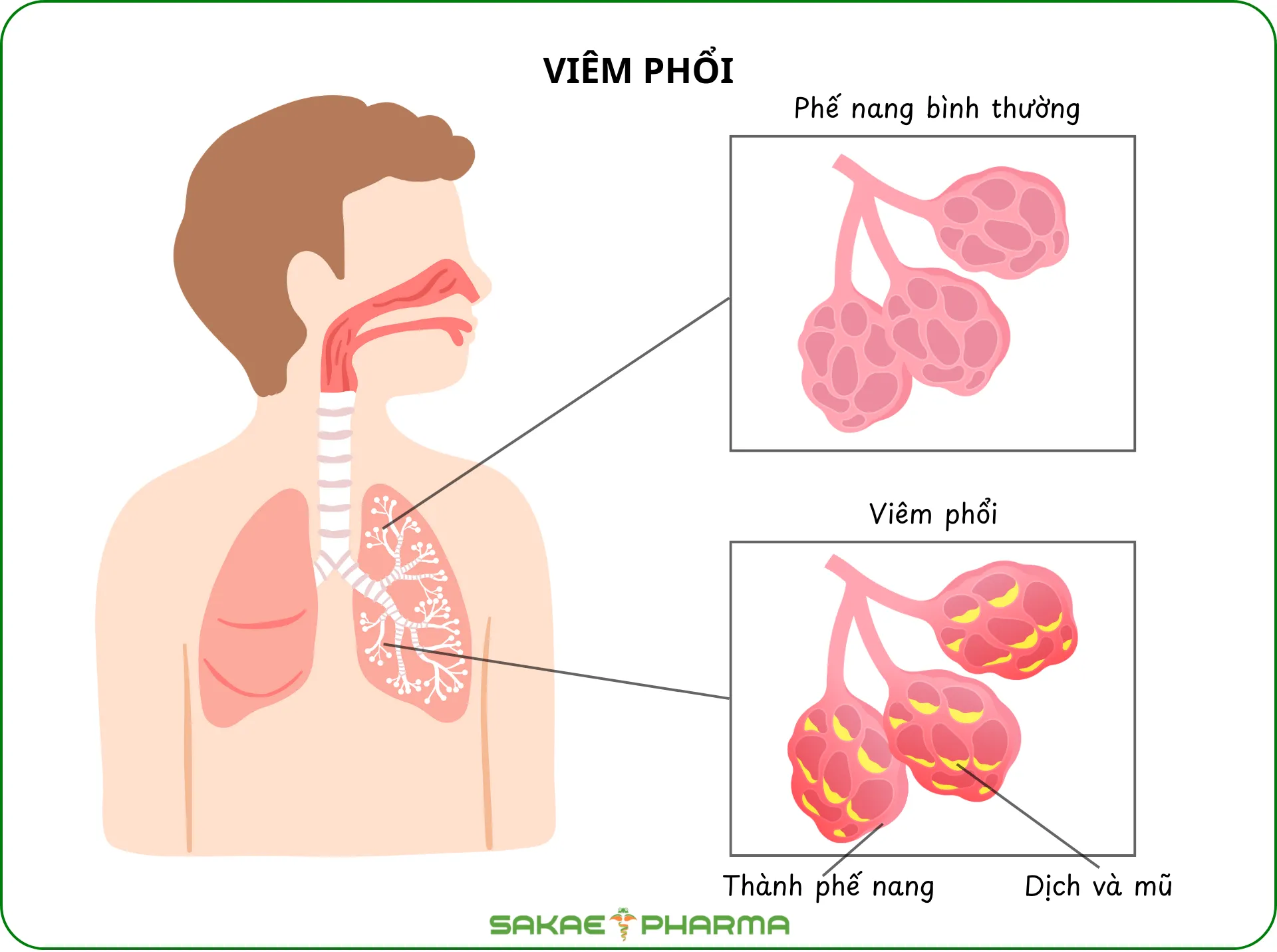 Viêm phổi