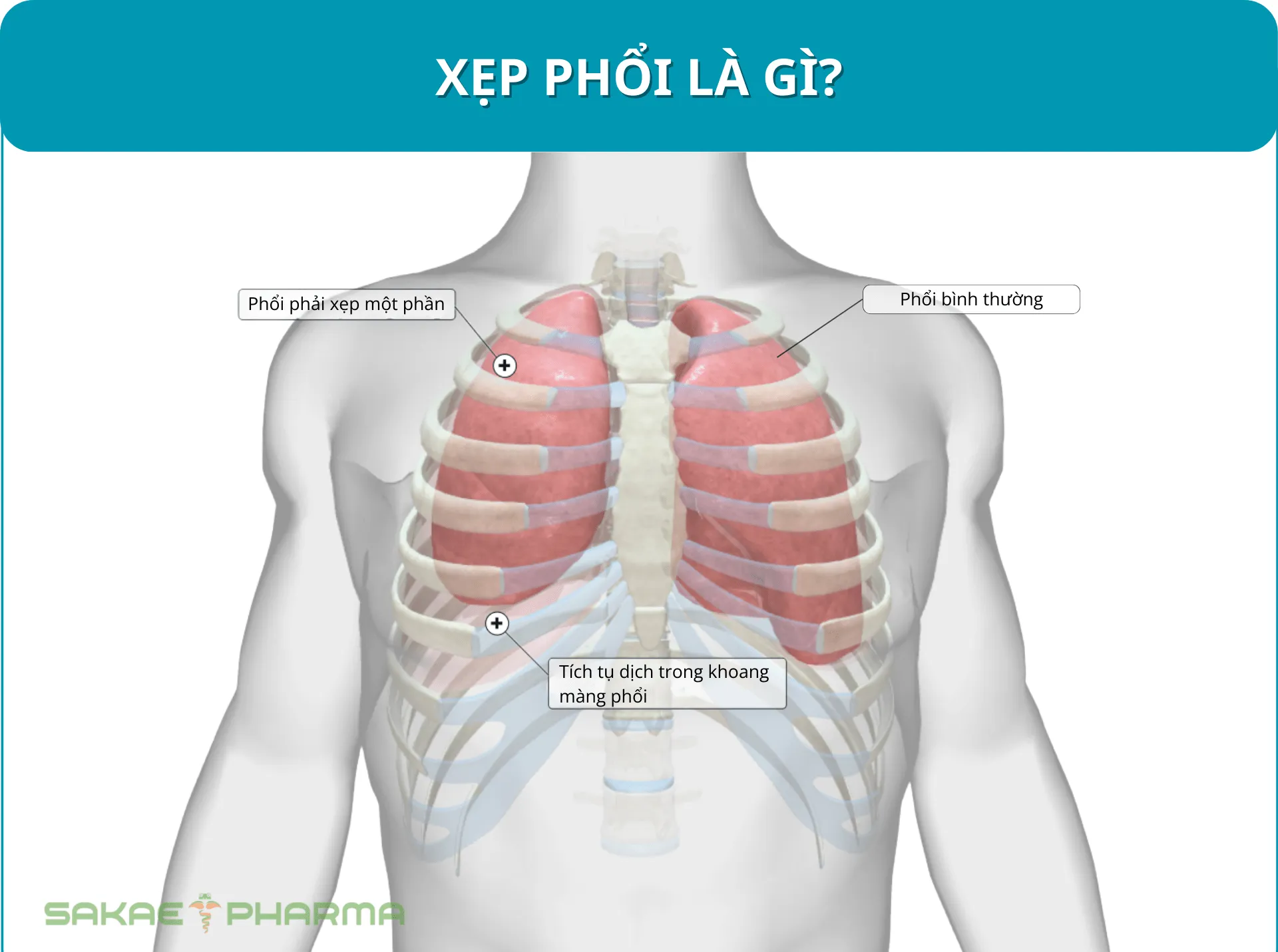 xẹp phổi là gì