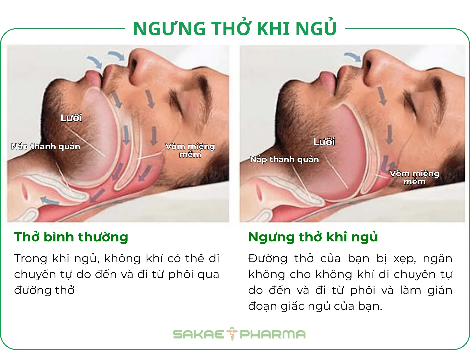 cách ngủ không ngáy