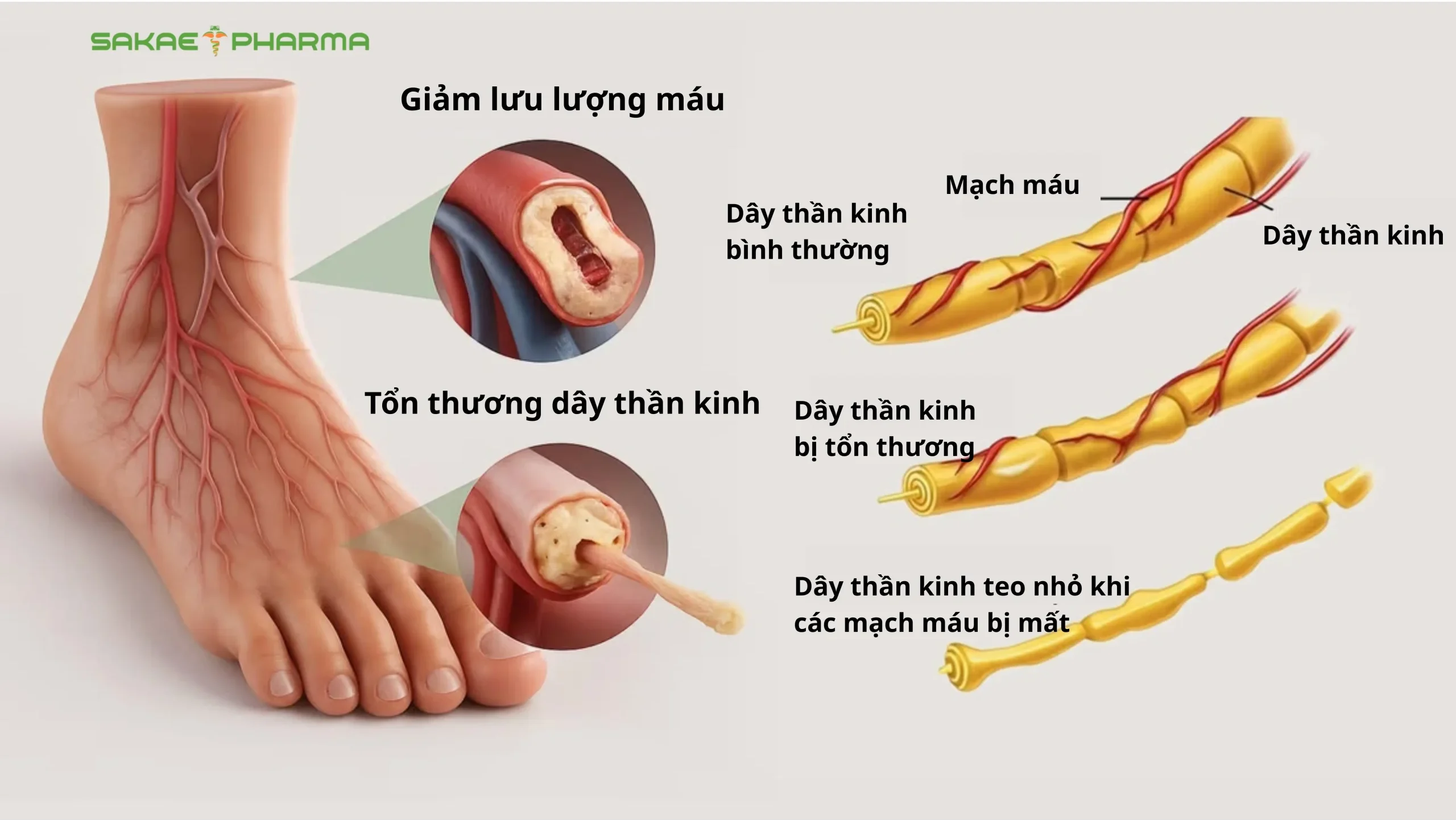 biến chứng thần kinh của bệnh tiểu đường