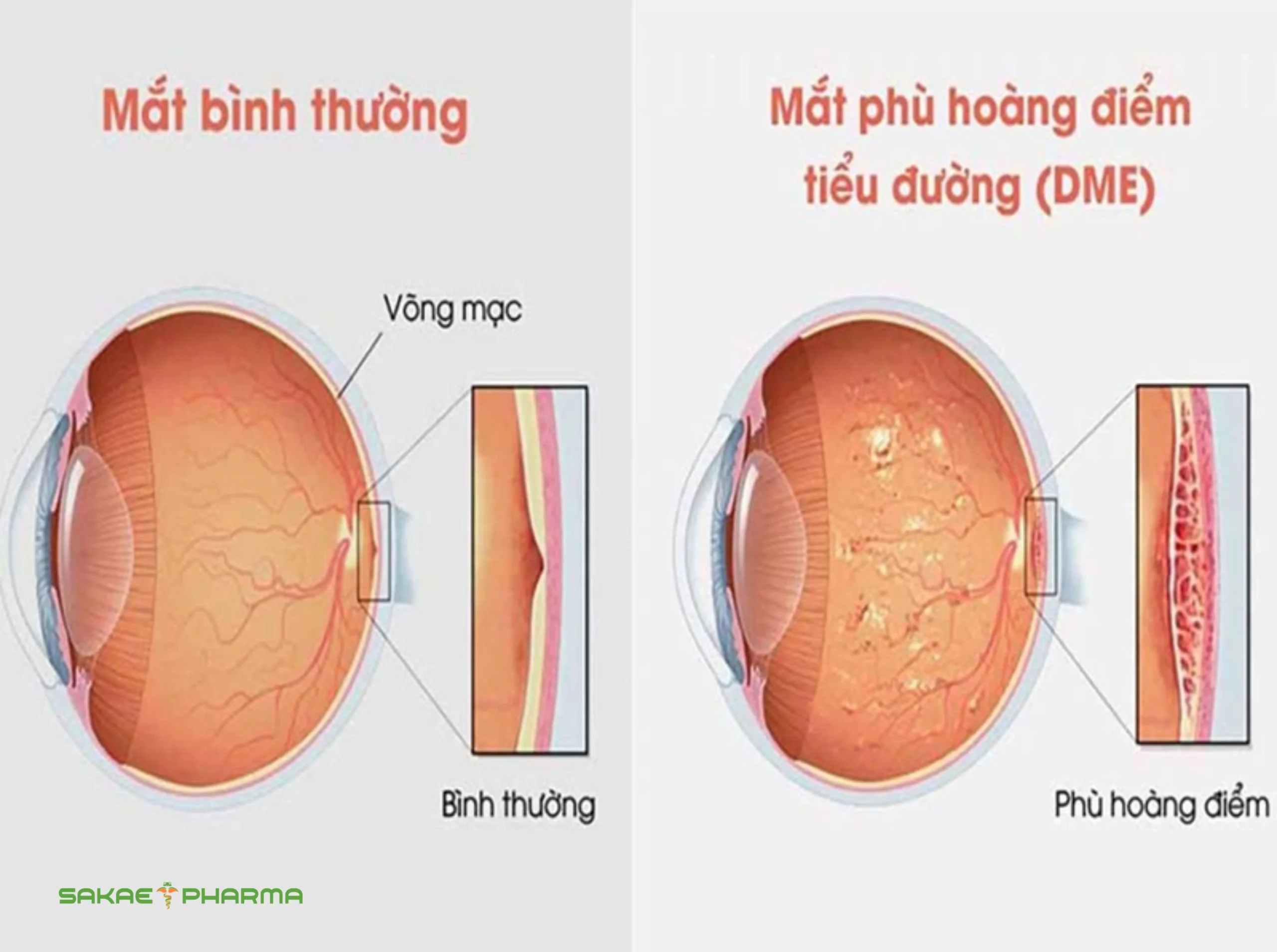 bệnh võng mạc đái tháo đường