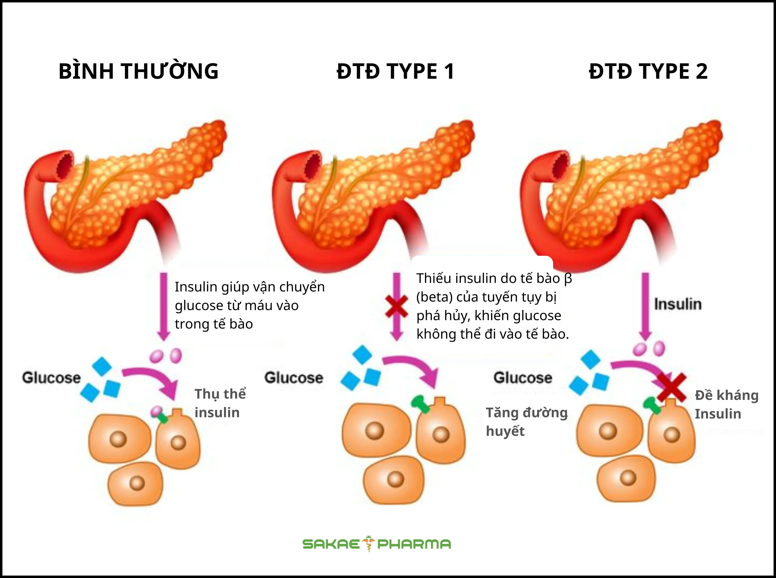 nguyên nhân gây ra bệnh tiểu đường