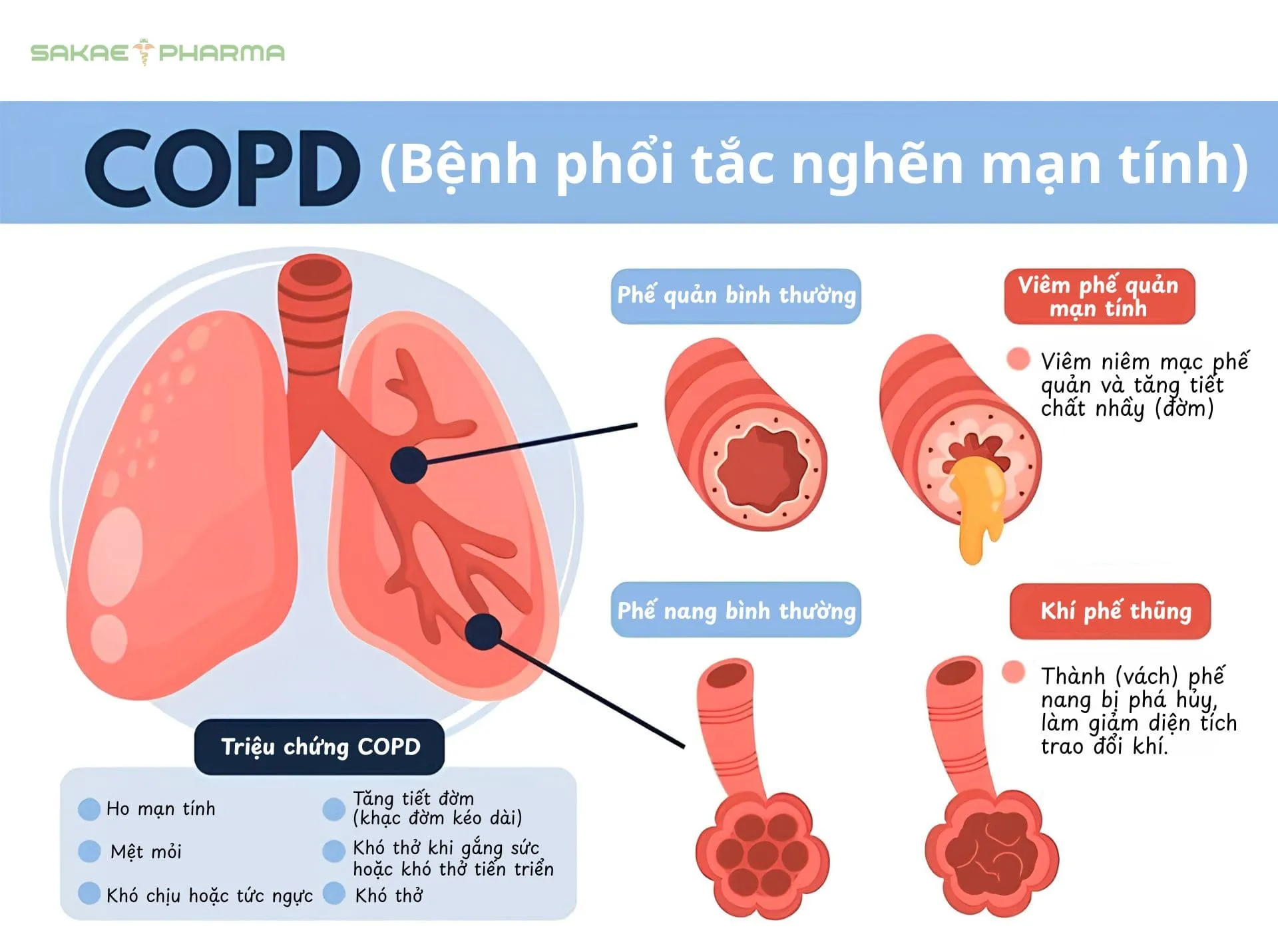 điều trị bệnh phổi tắc nghẽn mạn tính