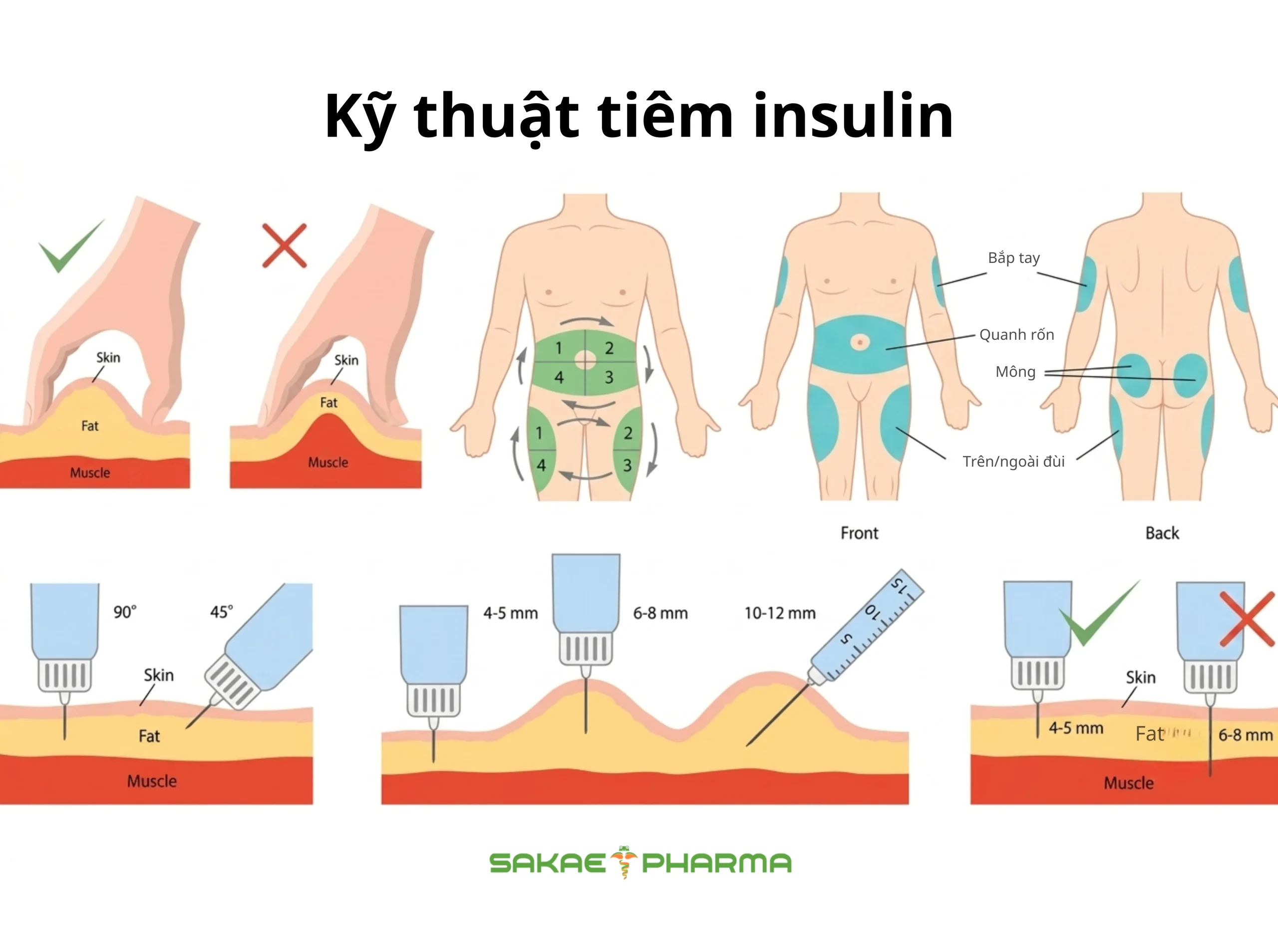 vị trí tiêm insulin