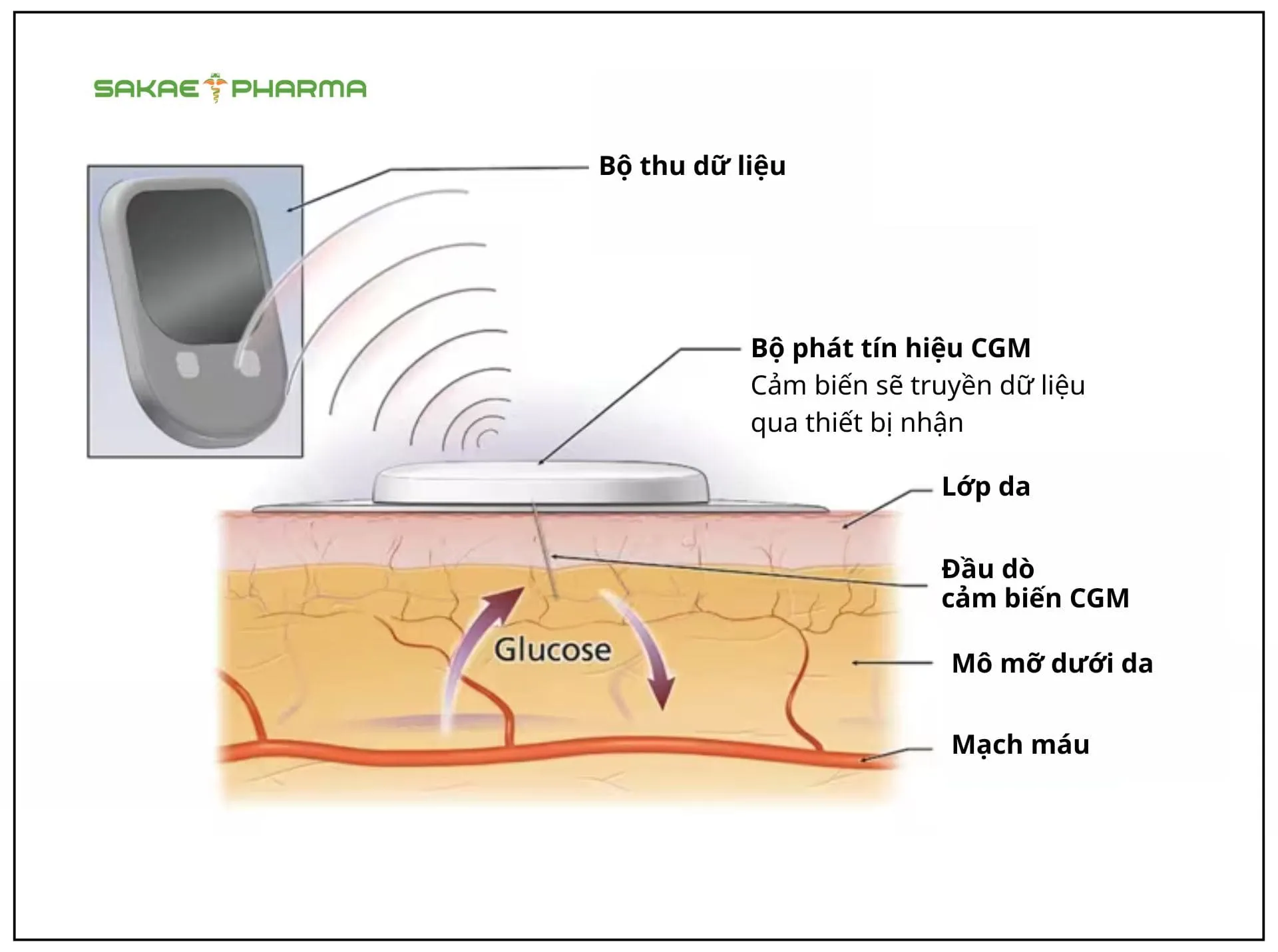 cgm là gì