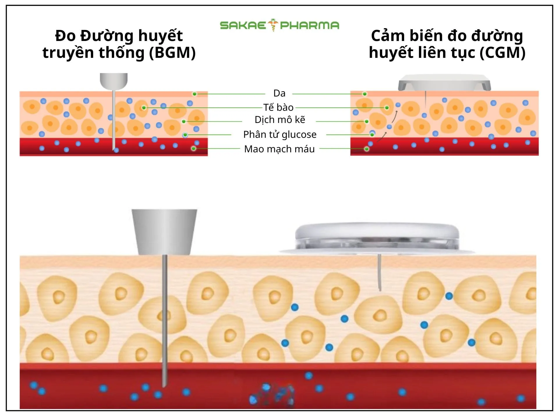 cgm là gì