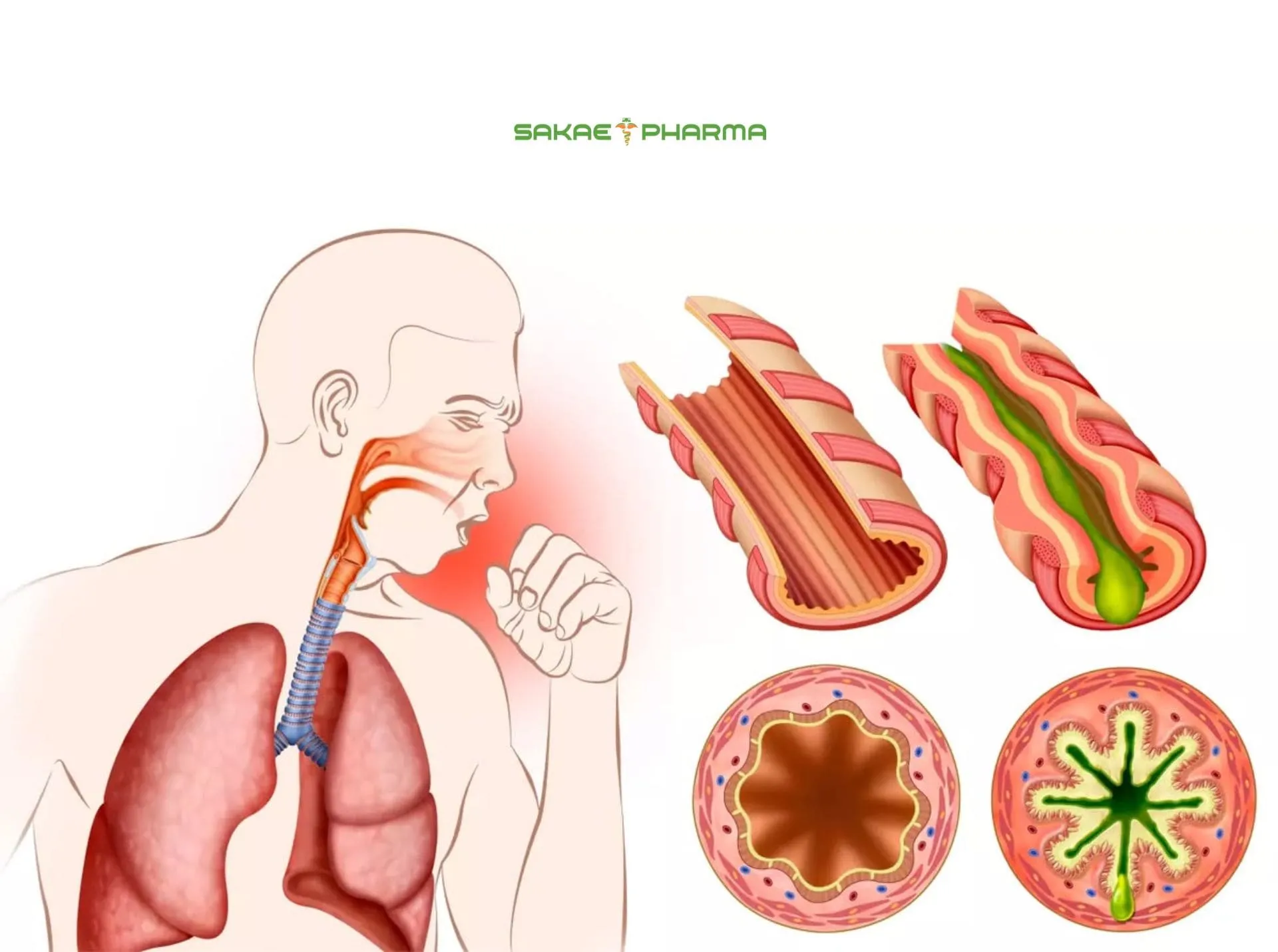 cách tống đờm ra khỏi cổ họng cho người bị copd