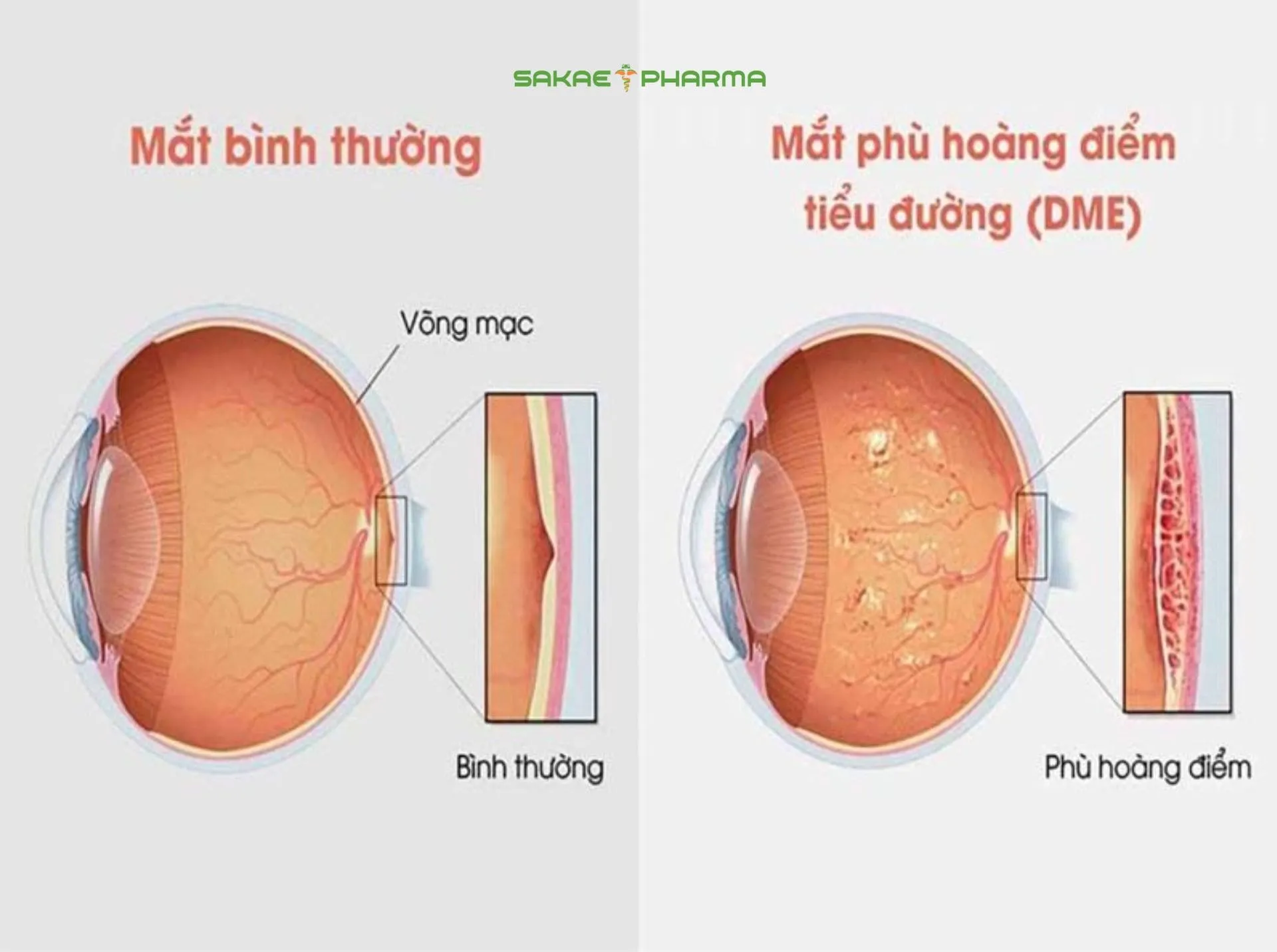 phù hoàng điểm do đái tháo đường