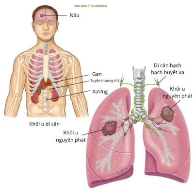 triệu chứng ung thư phổi