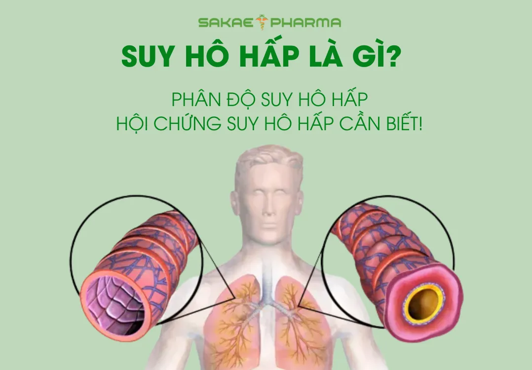 Suy hô hấp là gì? Phân độ suy hô hấp, hội chứng suy hô hấp cần biết