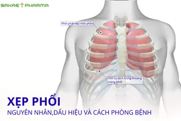 Xẹp phổi là gì? Nguyên nhân, dấu hiệu và cách phòng tránh hiệu quả