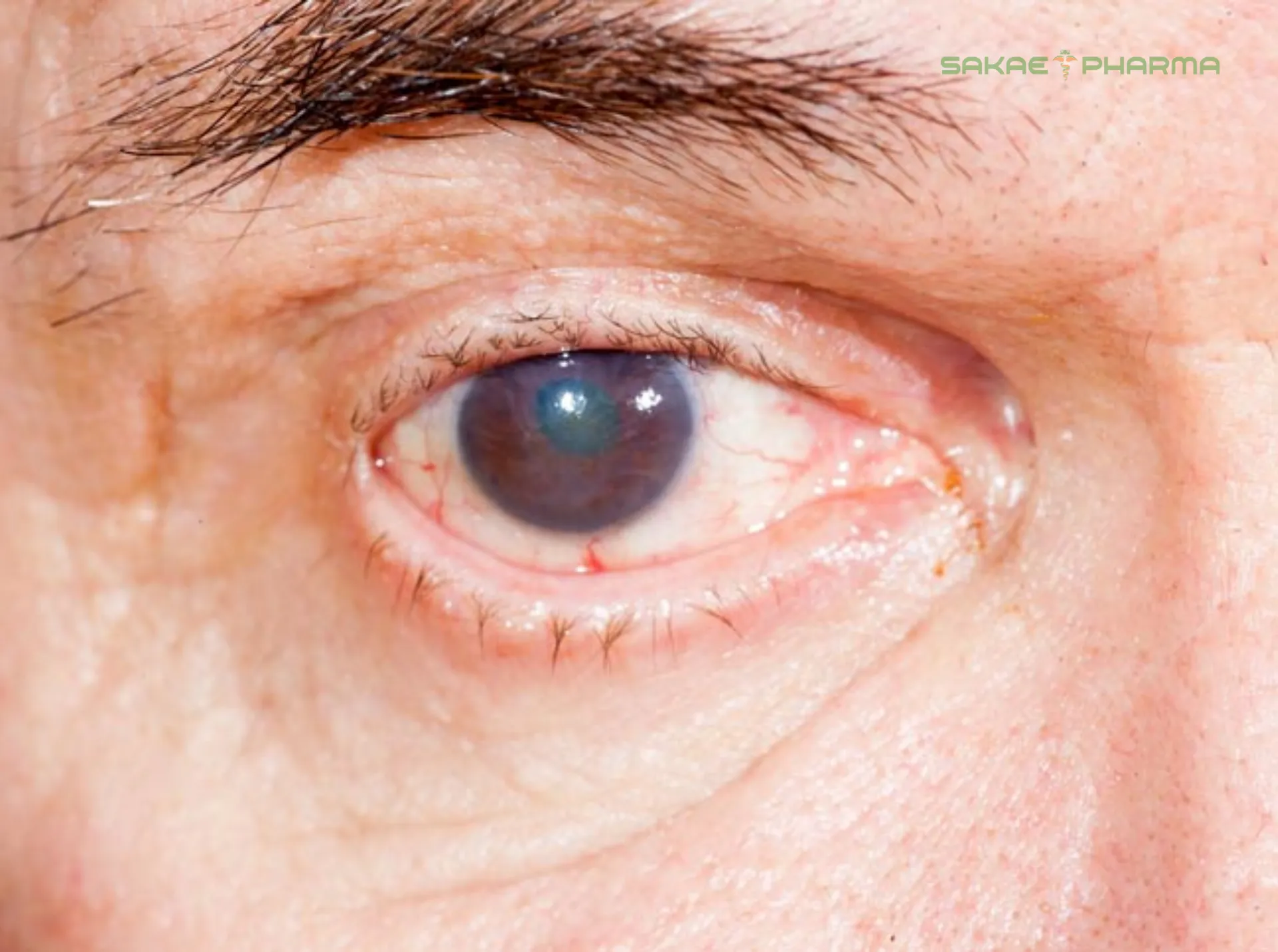 tại sao tiểu đường gây mờ mắt